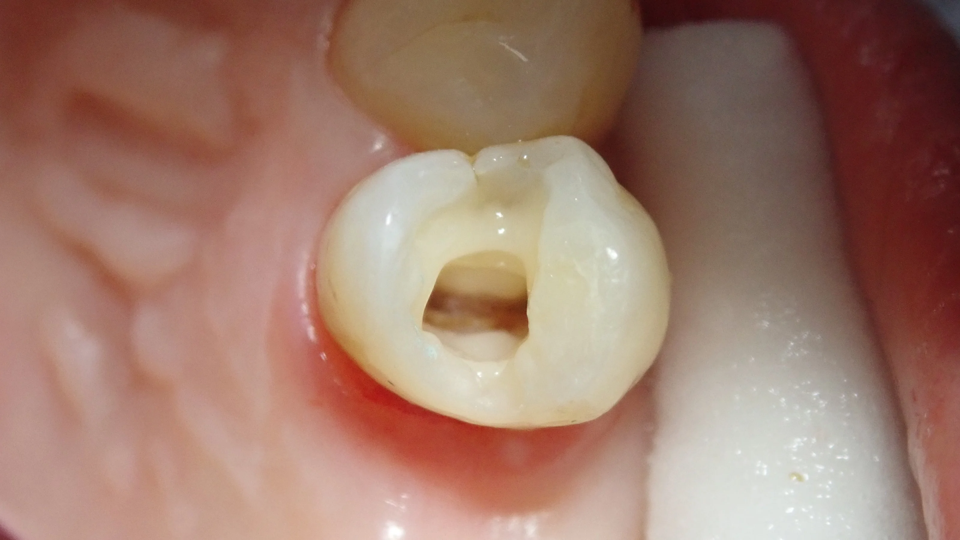 ダイレクトボンディング④｜坂寄歯科医院（取手市藤代） - 画像4