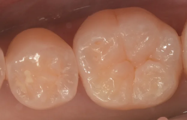 様子を見ていた所が進んだため治療介入。｜坂寄歯科医院（取手市藤代） - 画像4