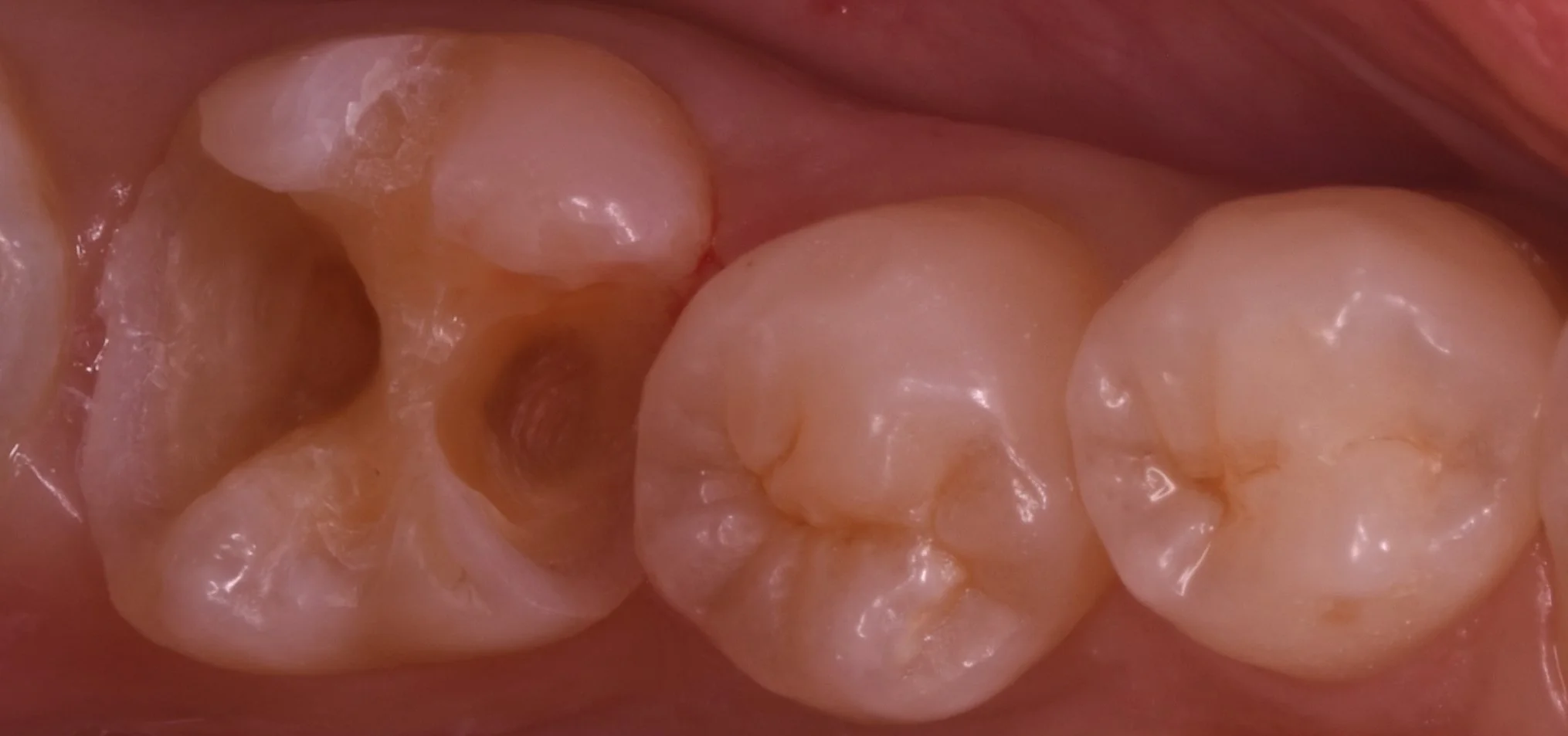 詰め物が脱離した所を即日で白い詰め物に。｜坂寄歯科医院（取手市藤代） - 画像3