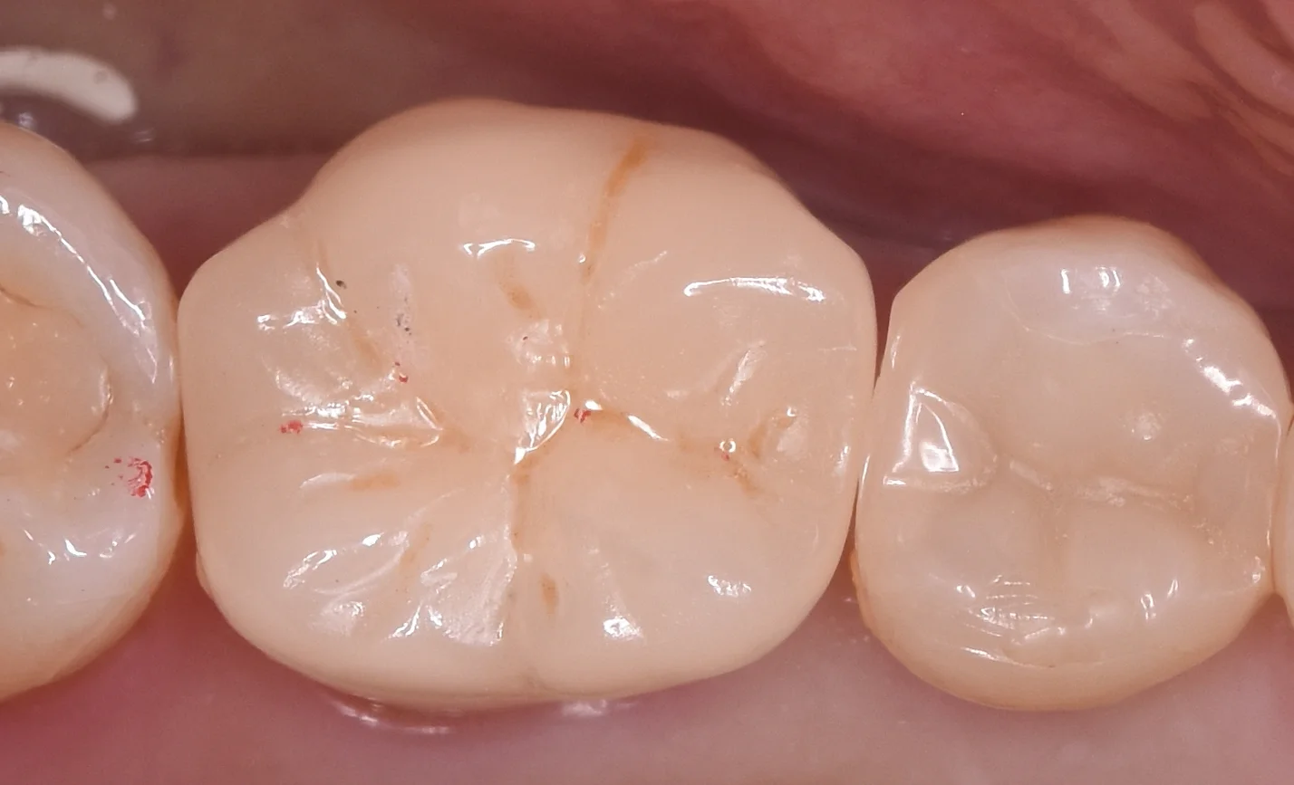 歯の亀裂で痛みが出たため、被せ物に。｜坂寄歯科医院（取手市藤代） - 画像3