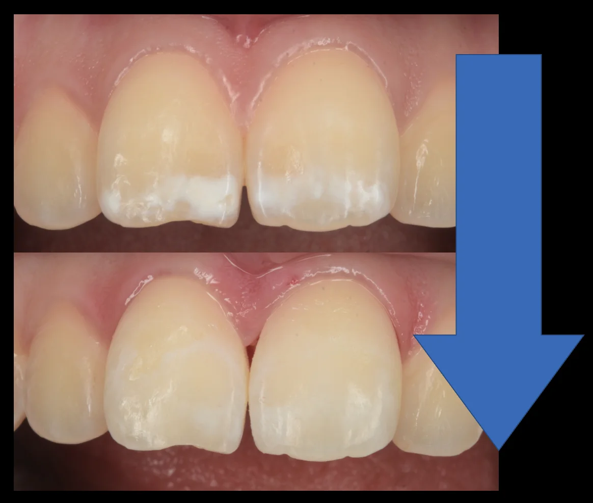 遠方よりICON治療を求めて・・・|坂寄歯科医院(取手市藤代) - 画像5