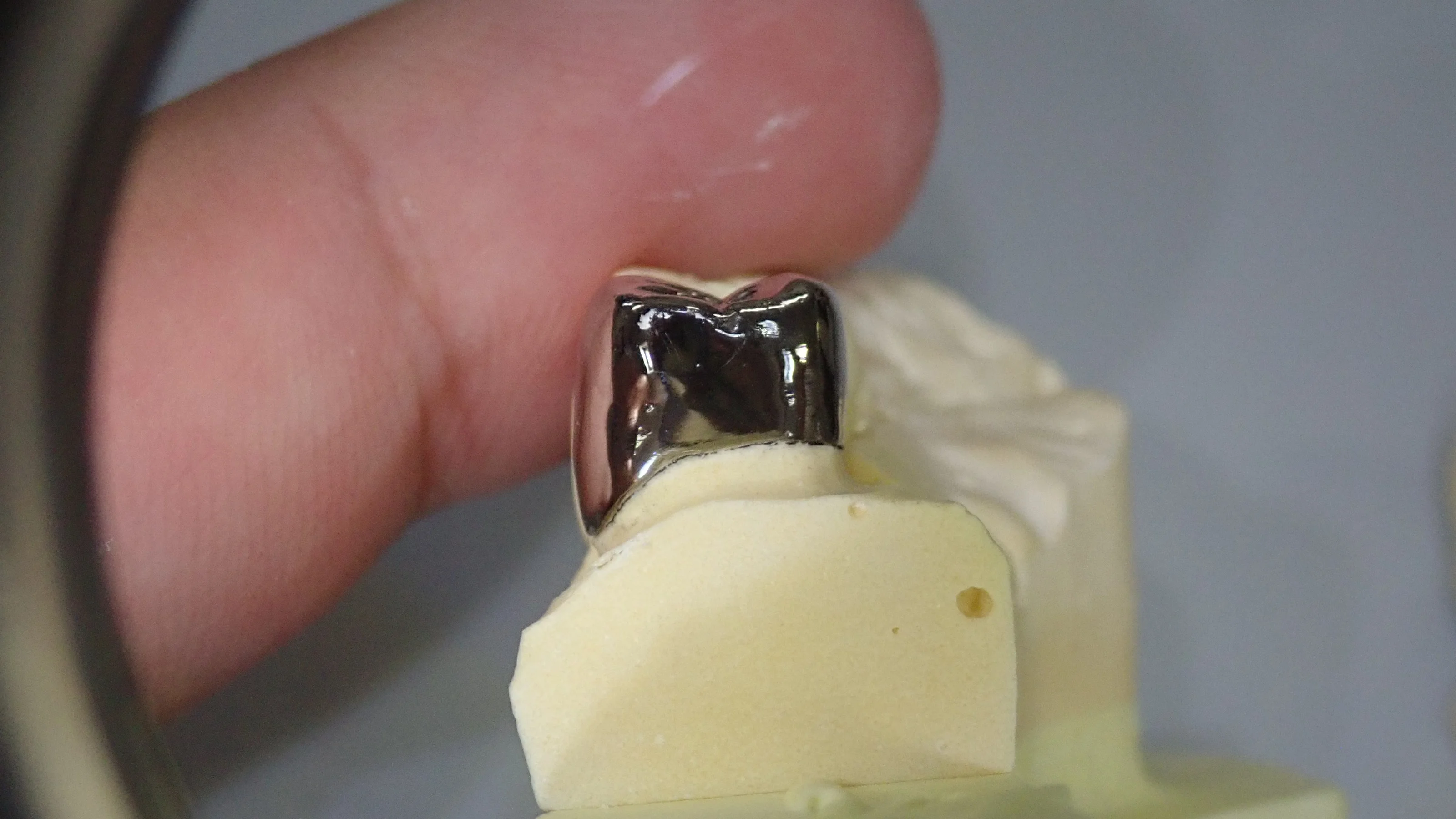 メタルクラウン｜坂寄歯科医院（取手市藤代） - 画像5