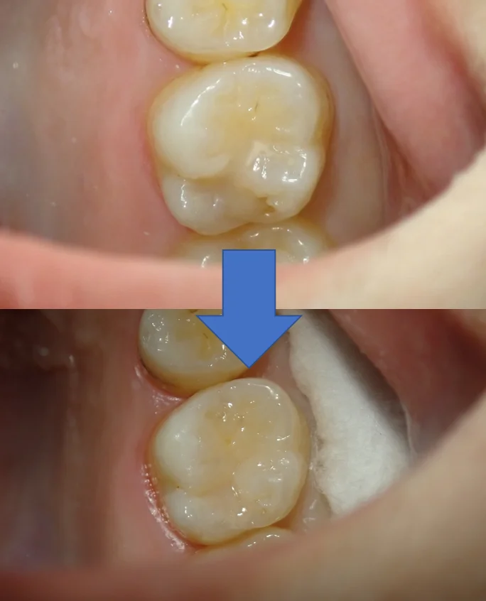 シールドレストレーション･･･？｜坂寄歯科医院（取手市藤代） - 画像6