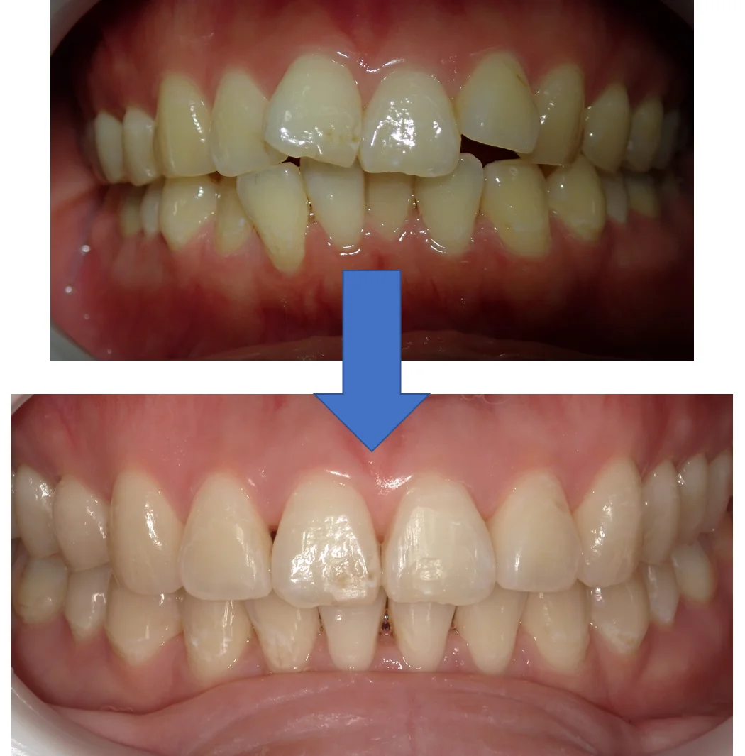 インビザライン矯正の術前術後｜坂寄歯科医院（取手市藤代） - 画像2