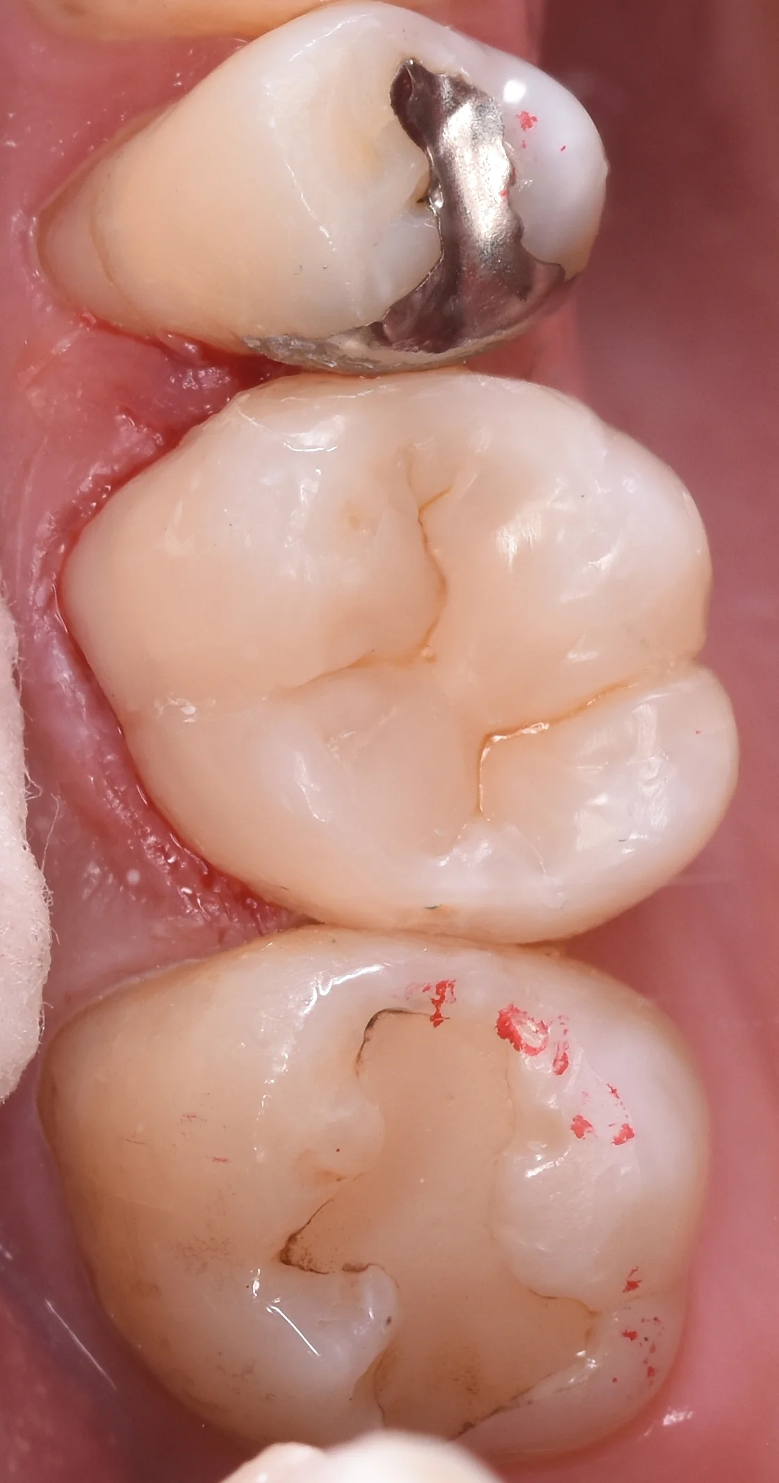 金属を白い詰め物に。｜坂寄歯科医院（取手市藤代） - 画像3