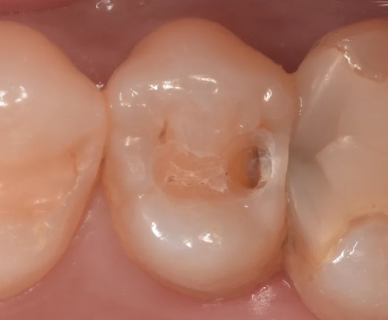 開業歯科医師の方を治療。｜坂寄歯科医院（取手市藤代） - 画像2