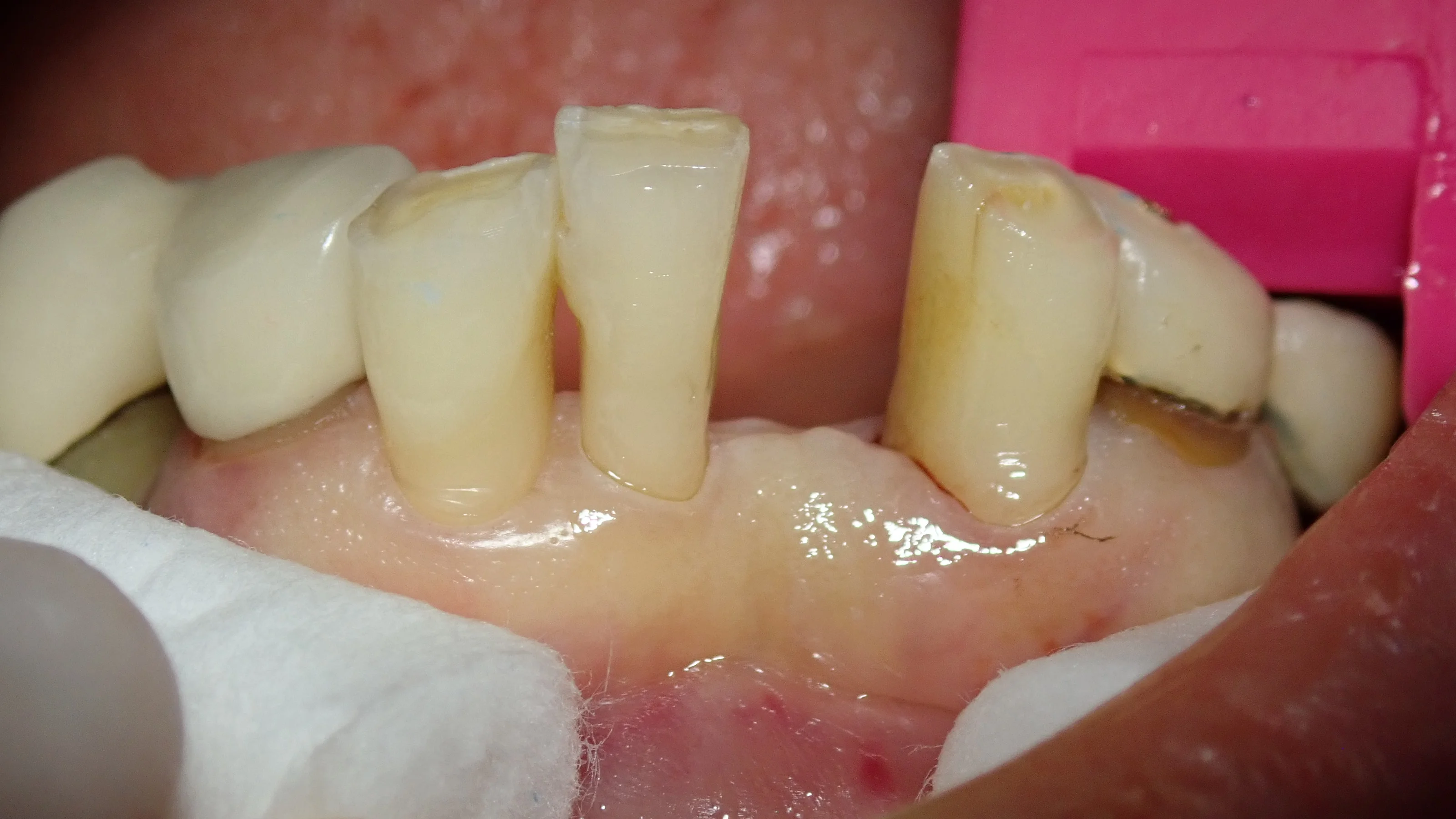 接着性ブリッジ｜坂寄歯科医院（取手市藤代） - 画像2