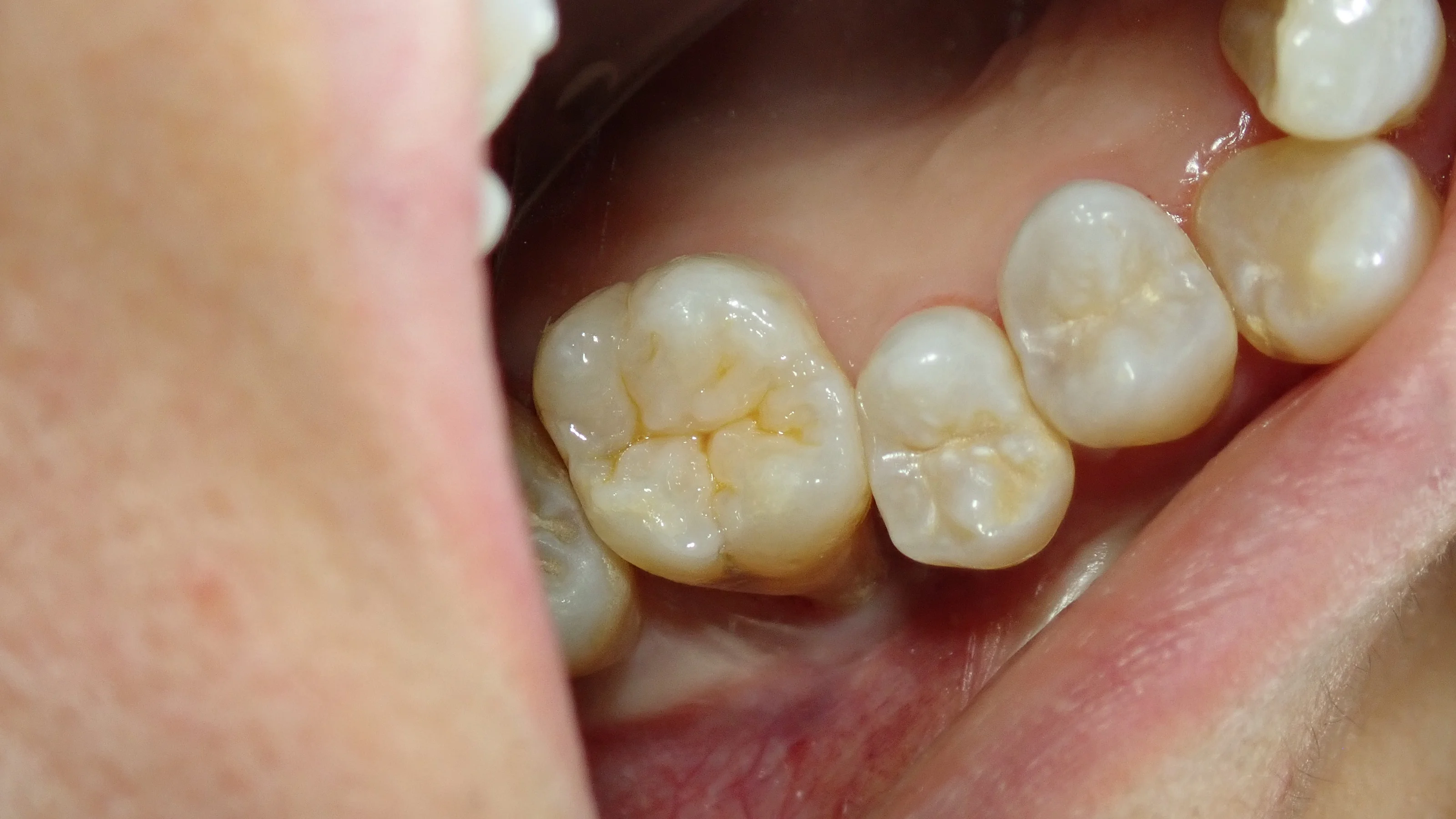 右上6ダイレクトボンディング｜坂寄歯科医院（取手市藤代） - 画像4