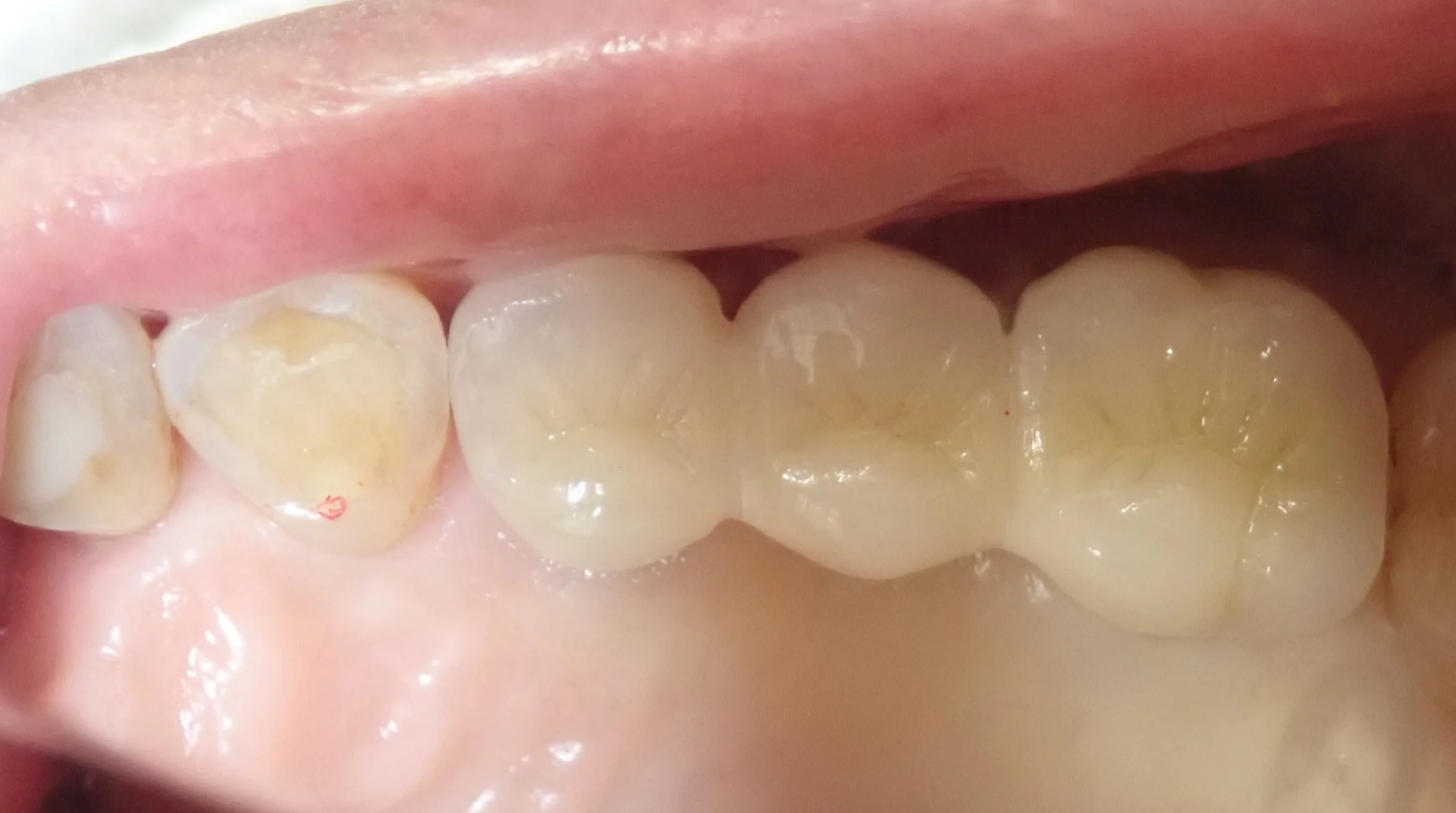 仮歯へのこだわり｜坂寄歯科医院（取手市藤代） - 画像4