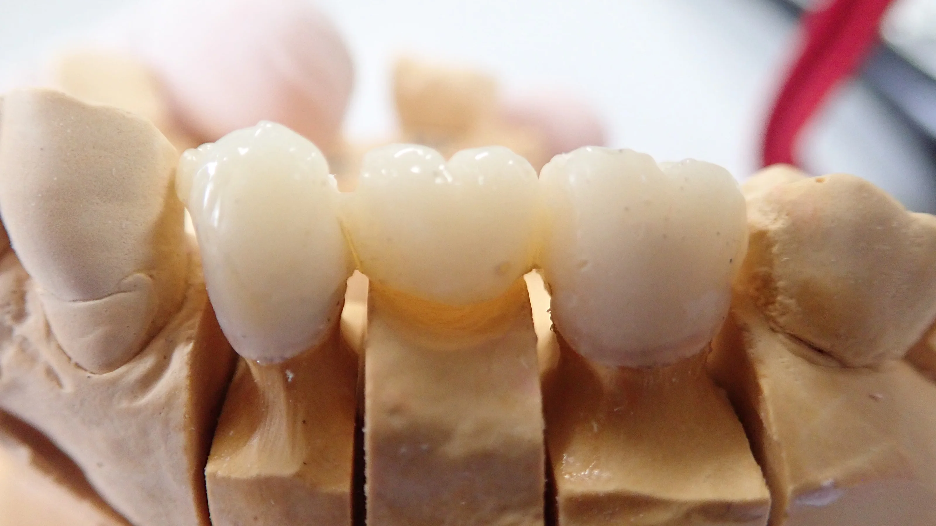 仮歯へのこだわり｜坂寄歯科医院（取手市藤代） - 画像2