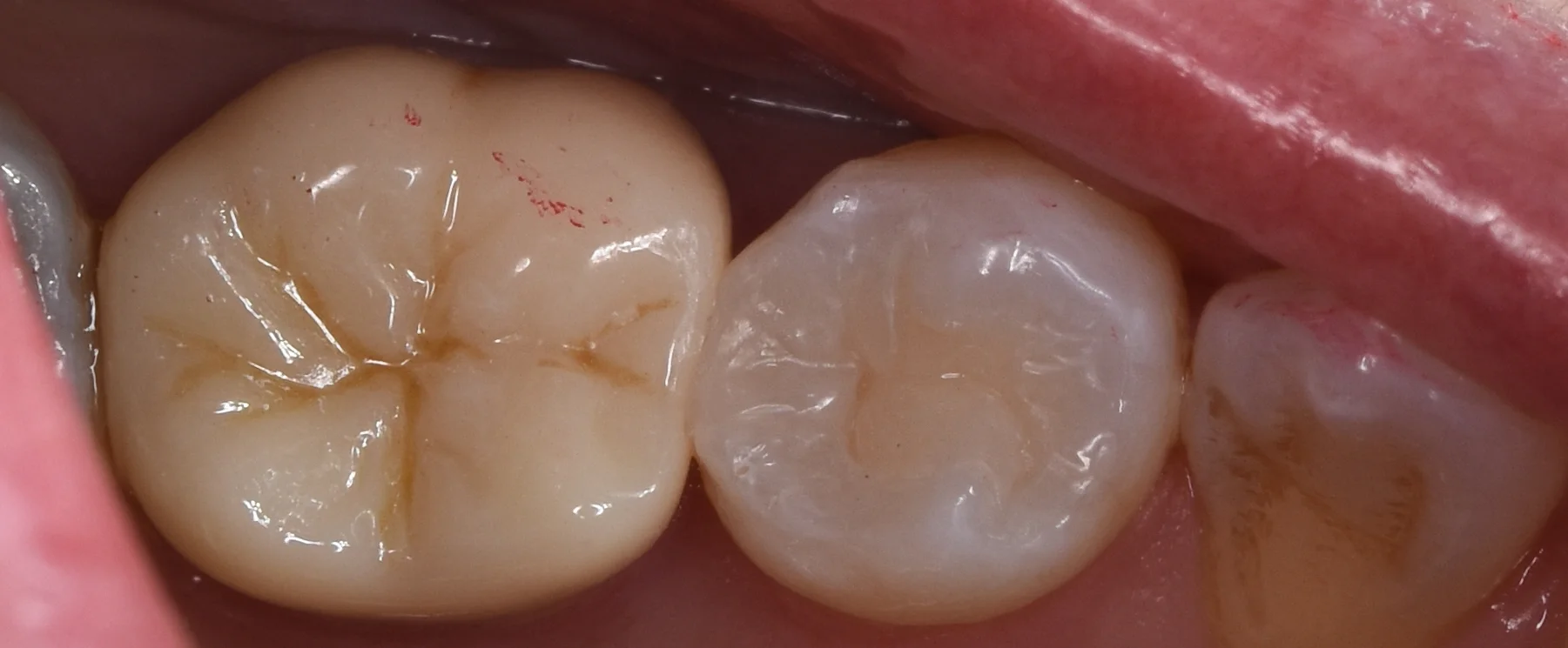 セラミックの被せ物｜坂寄歯科医院（取手市藤代） - 画像7