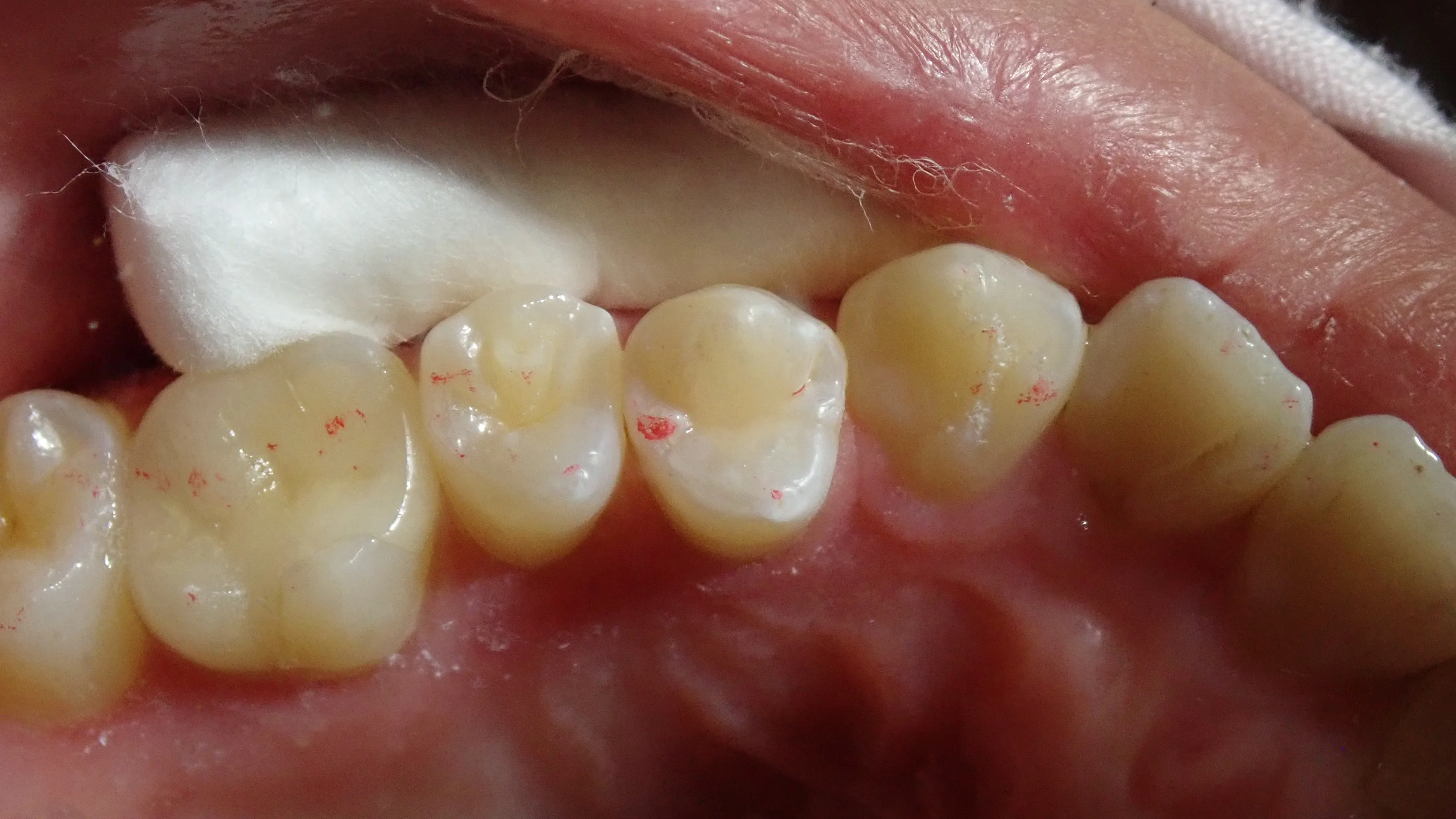 中心結節破折が原因で起こった神経の壊死を放置して、外部吸収が起こったケース｜坂寄歯科医院（取手市藤代） - 画像4