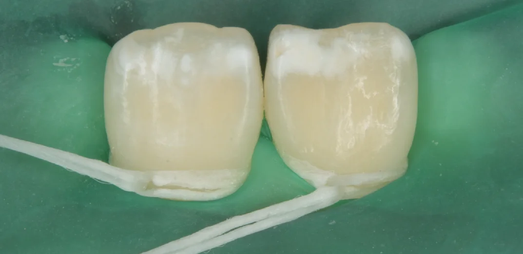 遠方よりICON治療を求めて・・・|坂寄歯科医院(取手市藤代) - 画像2