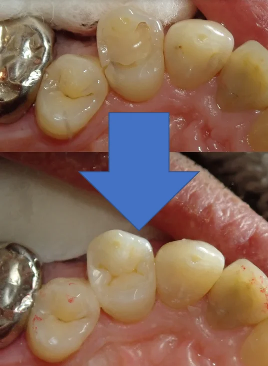 左上3本まとめてダイレクトボンディング|坂寄歯科医院(取手市藤代) - 画像4