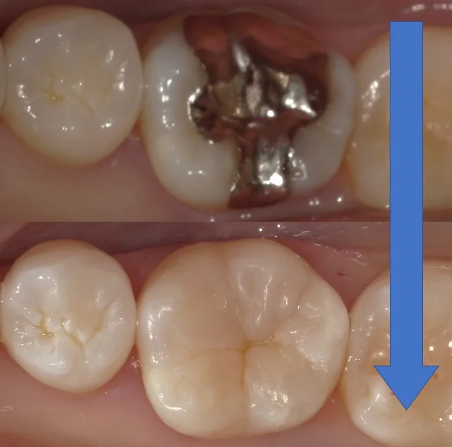 他院勤務中の歯科衛生士さんの治療を行いました。｜坂寄歯科医院（取手市藤代） - 画像4