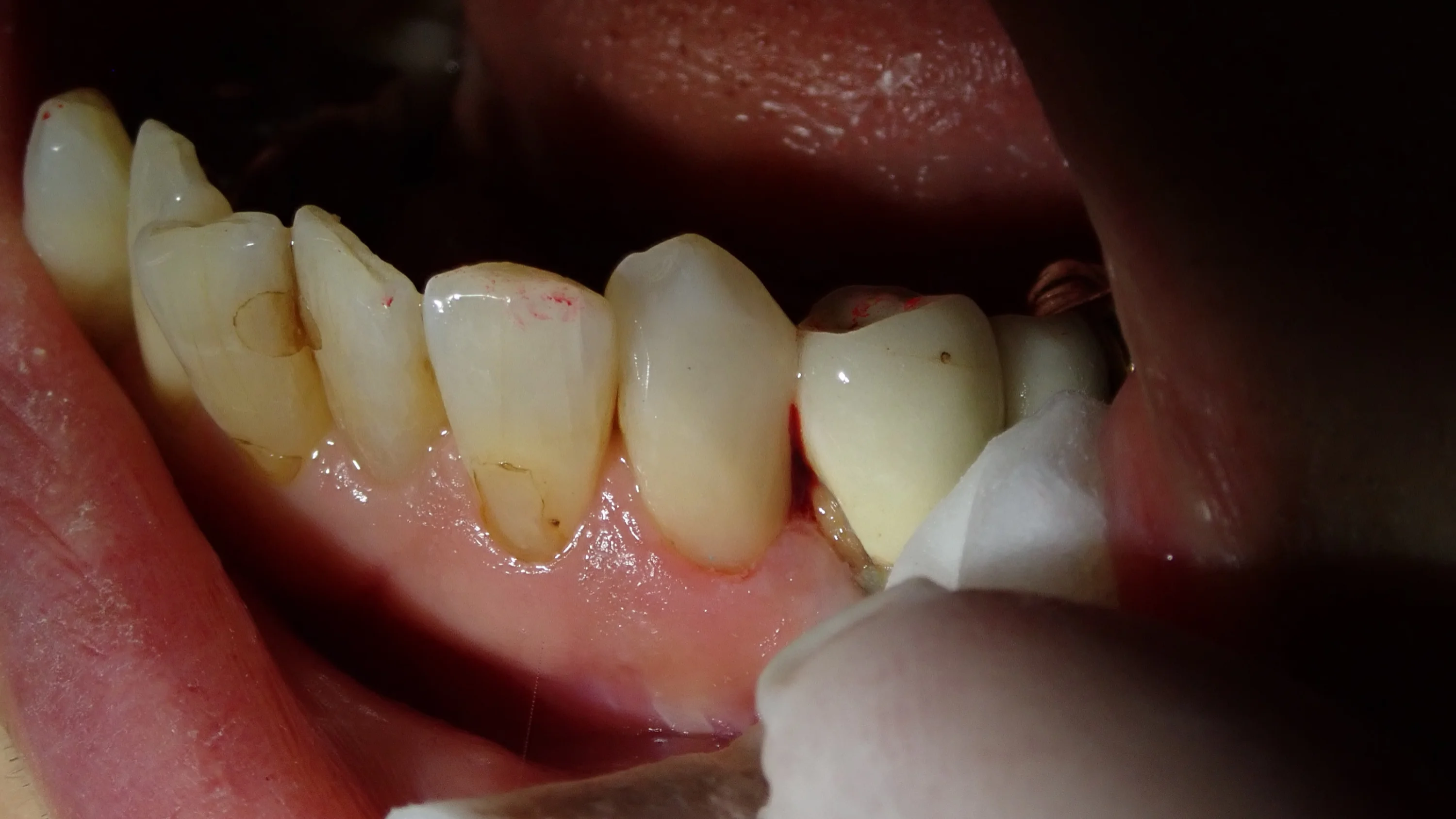 下顎前歯ダイレクトボンディング｜坂寄歯科医院（取手市藤代） - 画像3