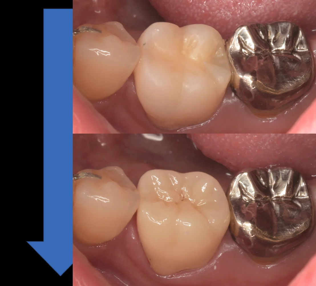 神経の治療後をセラミックで。｜坂寄歯科医院（取手市藤代） - 画像4