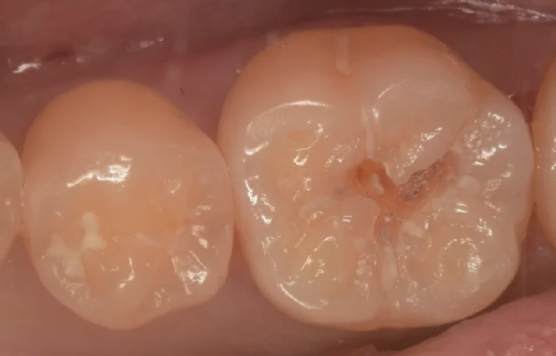 様子を見ていた所が進んだため治療介入。｜坂寄歯科医院（取手市藤代） - 画像2