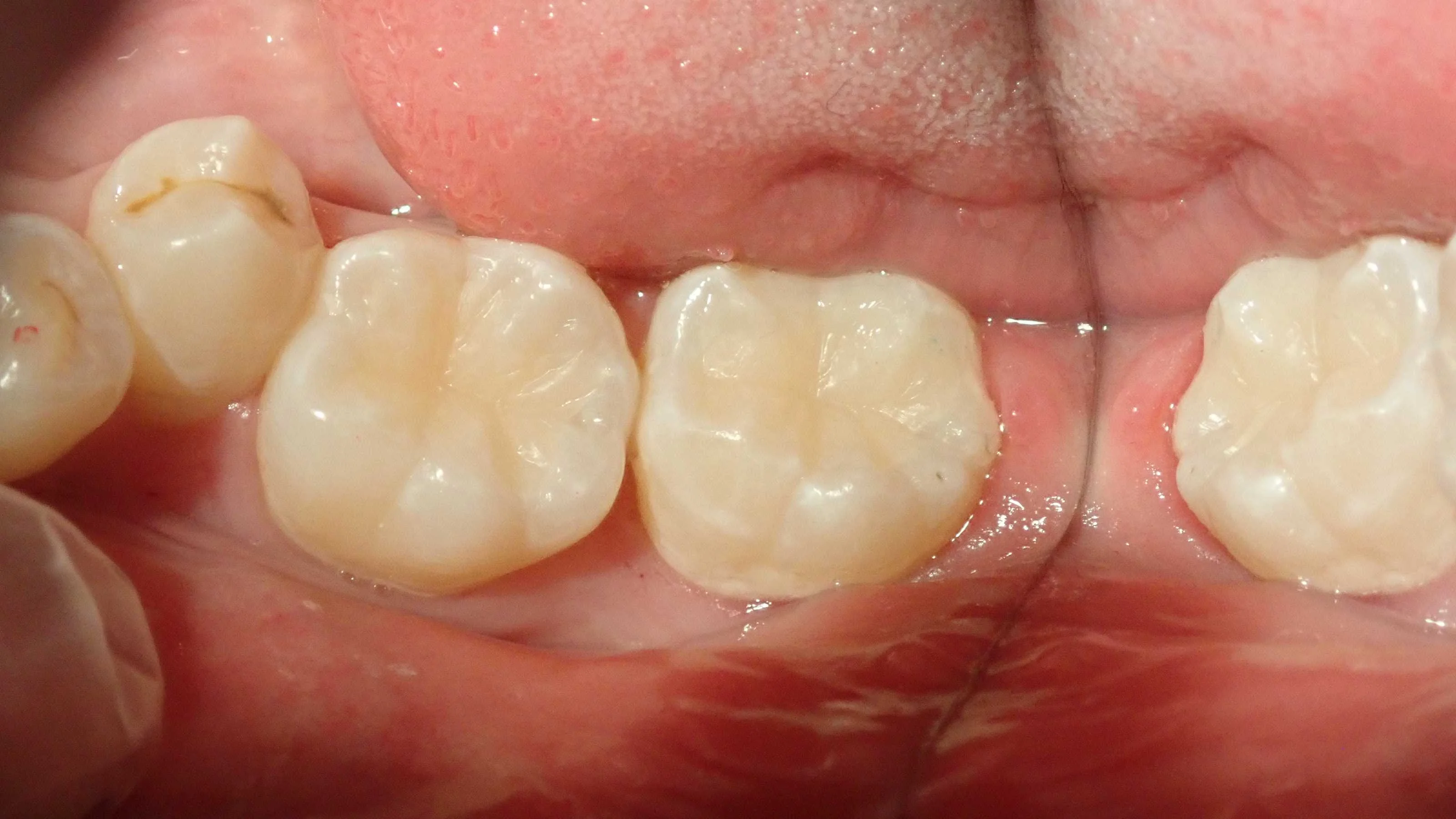 コンポジットレジン修復｜坂寄歯科医院（取手市藤代） - 画像3