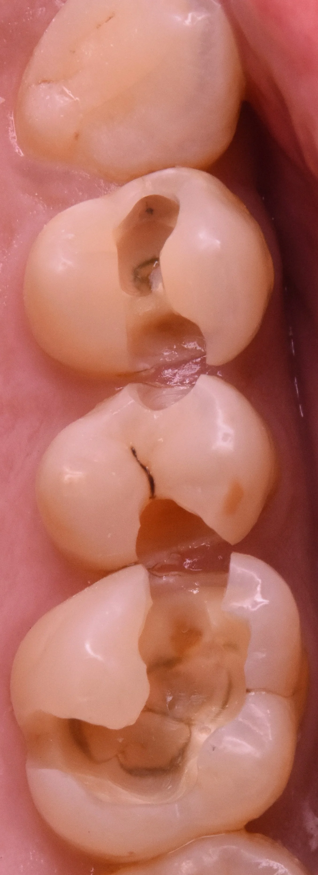 奥歯3本を纏めて一気に治療。｜坂寄歯科医院（取手市藤代） - 画像3