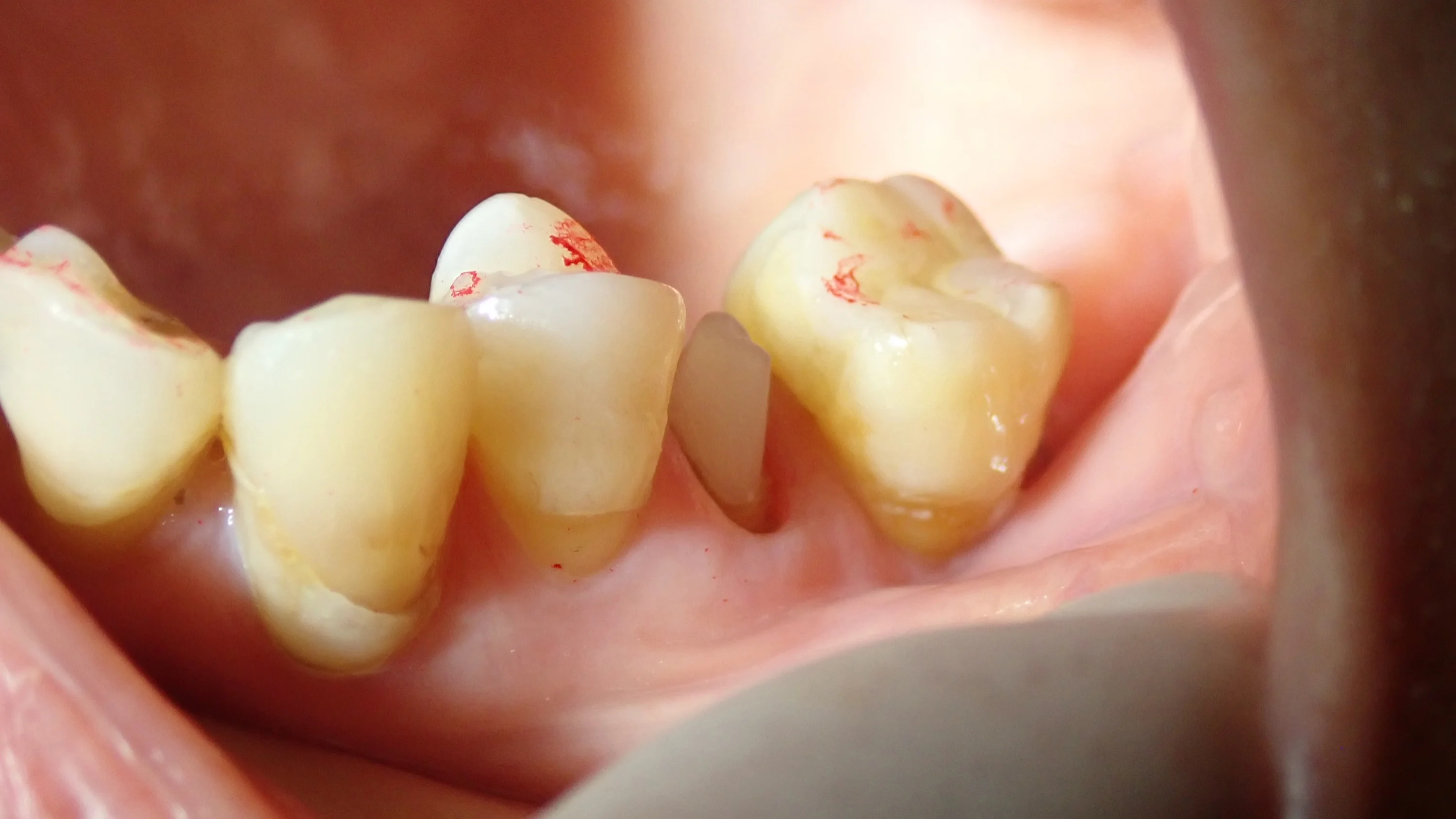 口腔内スキャナーでのセラミック｜坂寄歯科医院（取手市藤代） - 画像3