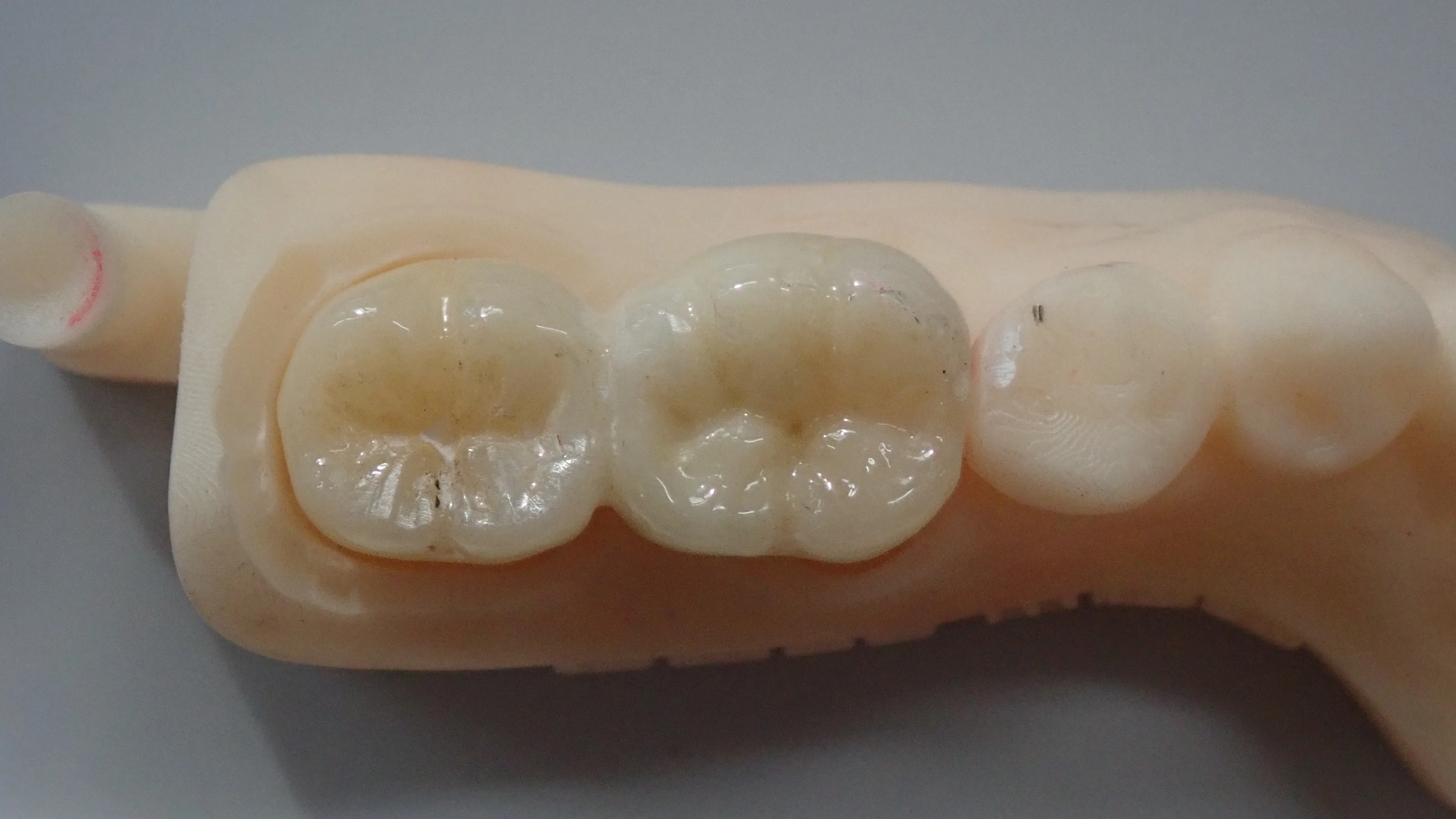 その抜歯ちょっと待って!|坂寄歯科医院(取手市藤代) - 画像5