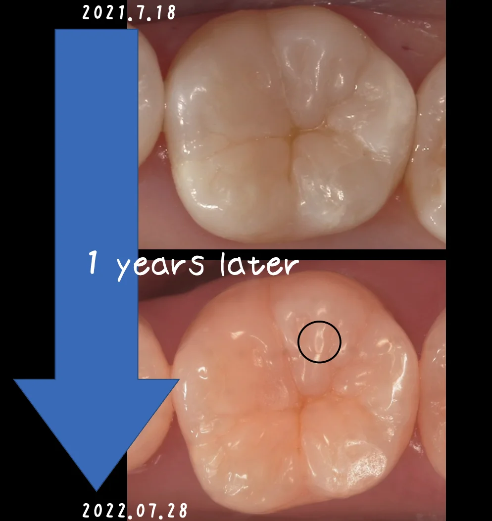 ダイレクトボンディングの長期経過｜坂寄歯科医院（取手市藤代） - 画像2