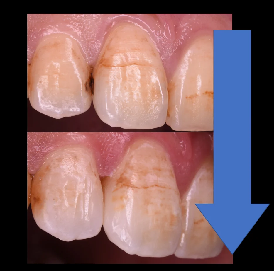 前歯の虫歯の治療で可能な限り歯を温存したケース。|坂寄歯科医院(取手市藤代) - 画像5