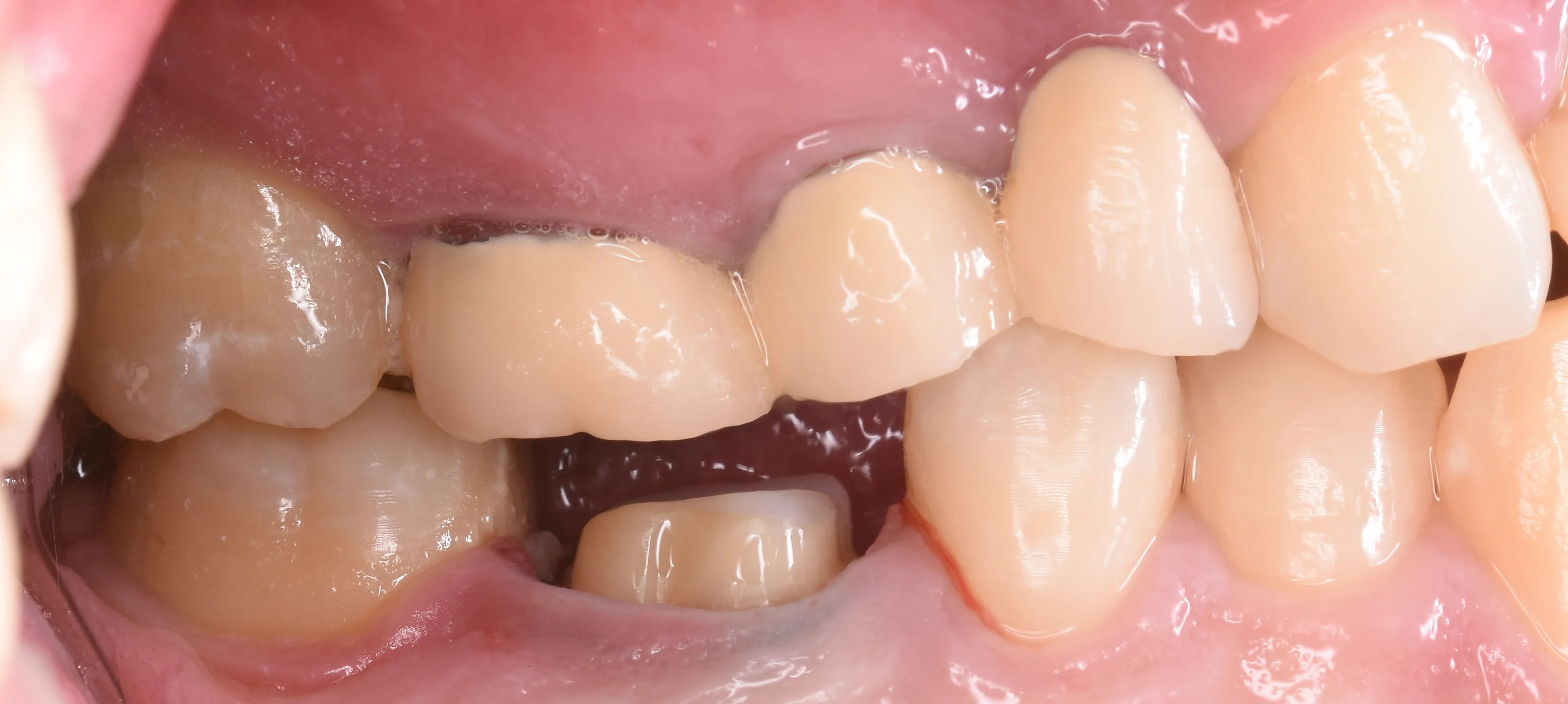 セラミックの被せ物｜坂寄歯科医院（取手市藤代） - 画像3