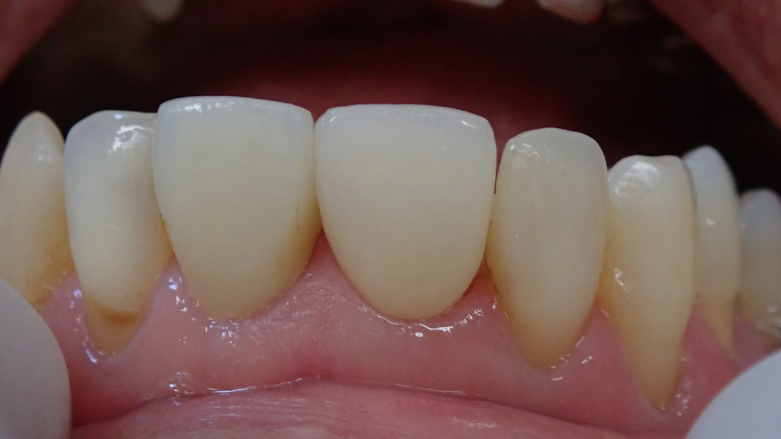 仮歯へのこだわり。その２｜坂寄歯科医院（取手市藤代） - 画像3