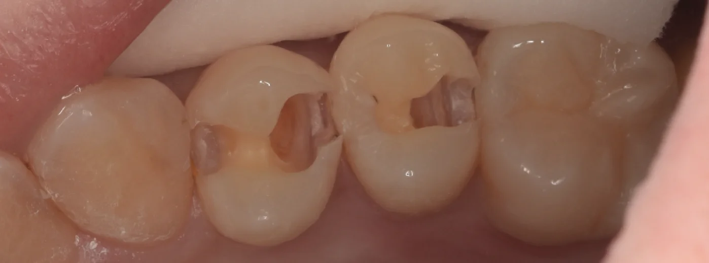 通常の保険診療。｜坂寄歯科医院（取手市藤代） - 画像3