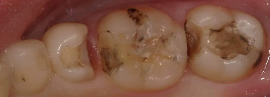 １回で纏めて一気に白い歯へ。｜坂寄歯科医院（取手市藤代） - 画像2