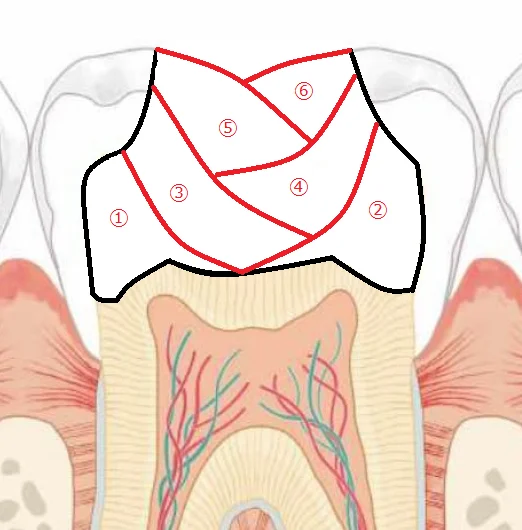 【歯科医師向け】重合収縮のコントロールについて【1級窩洞編】｜坂寄歯科医院（取手市藤代） - 画像4