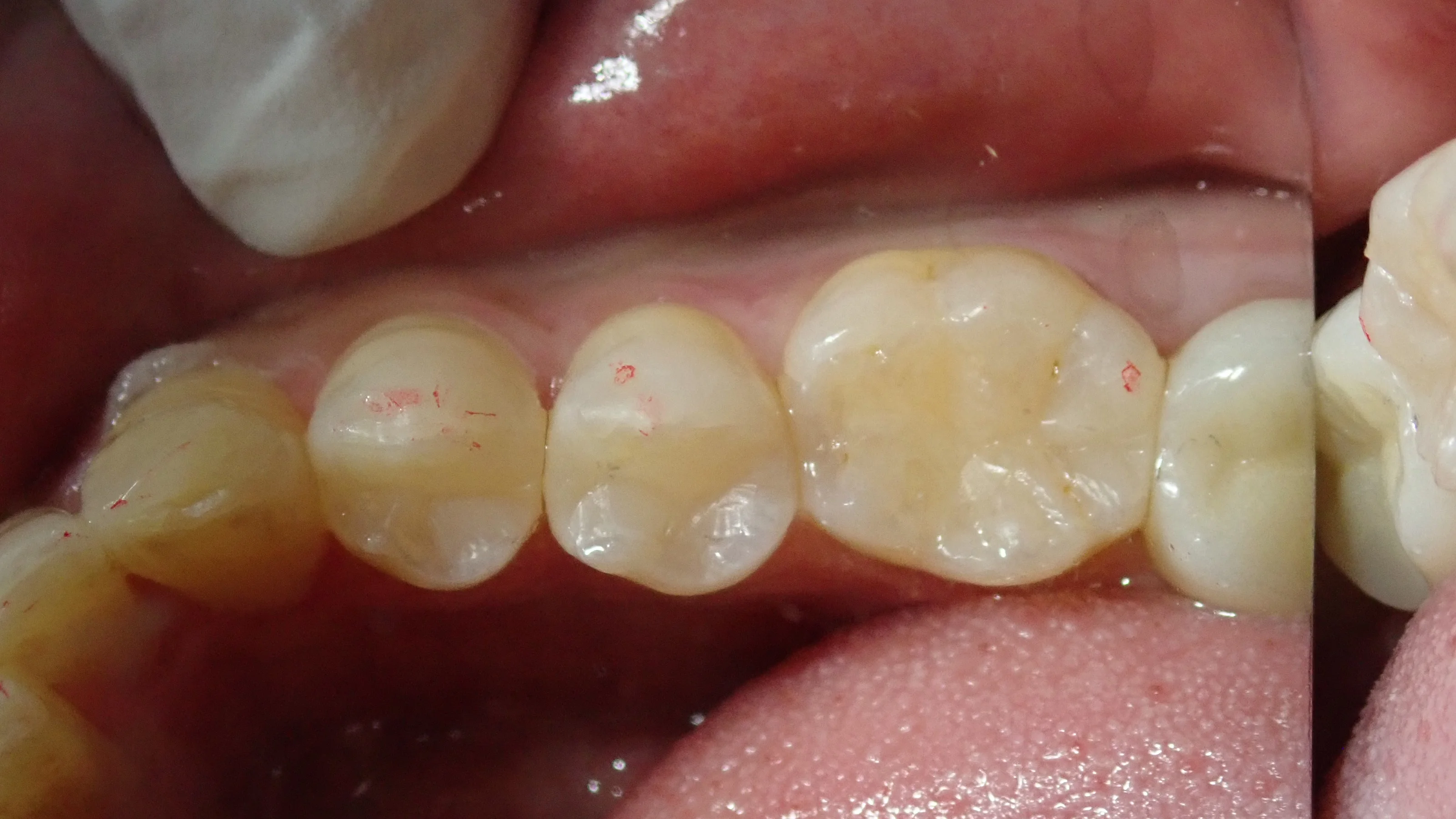 保険の白い詰め物(一気に3本)|坂寄歯科医院(取手市藤代) - 画像4