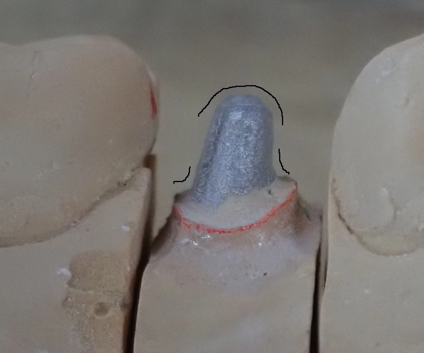 保険の白い被せ物｜坂寄歯科医院（取手市藤代） - 画像2