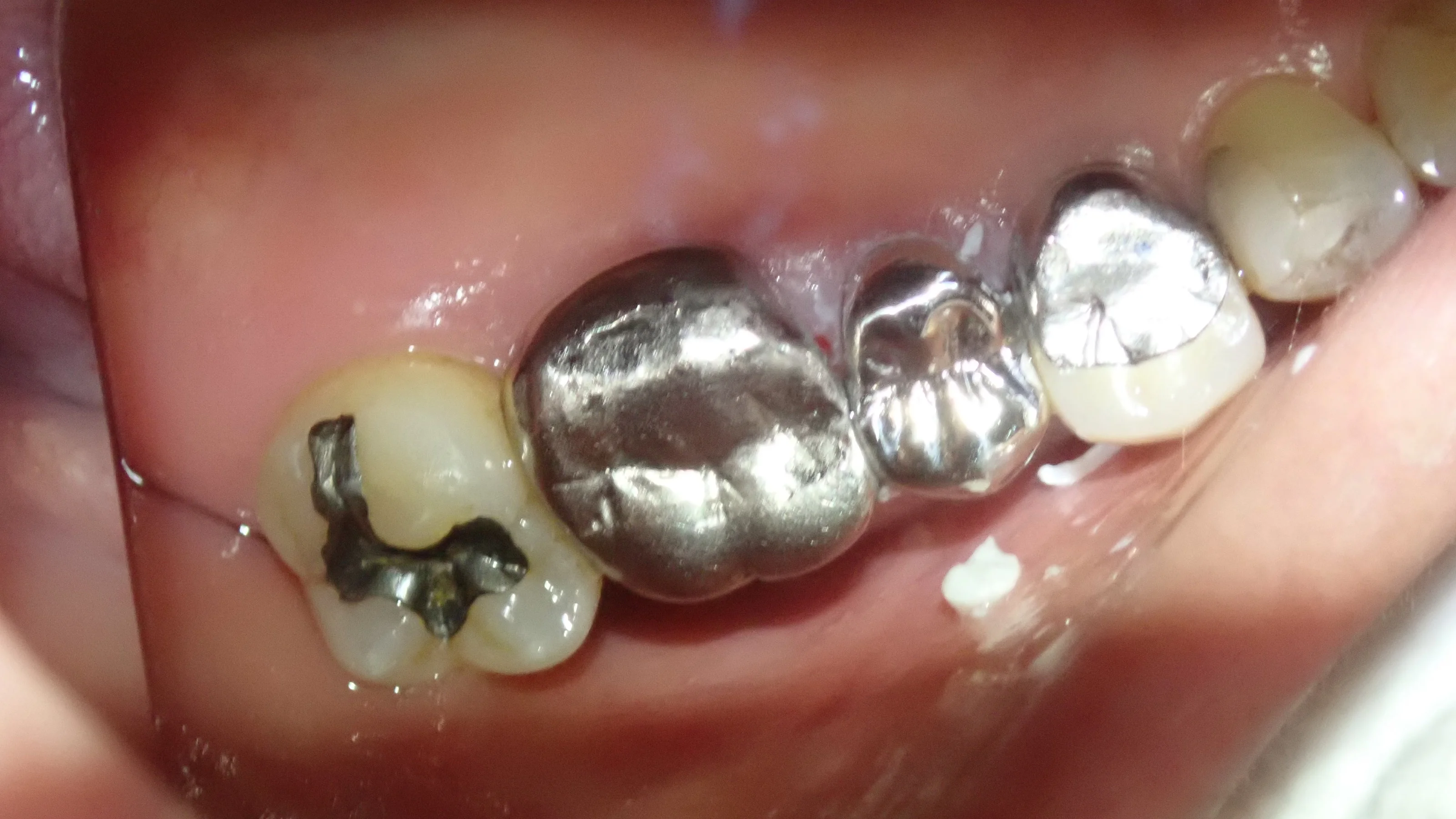 メタルクラウン｜坂寄歯科医院（取手市藤代） - 画像7