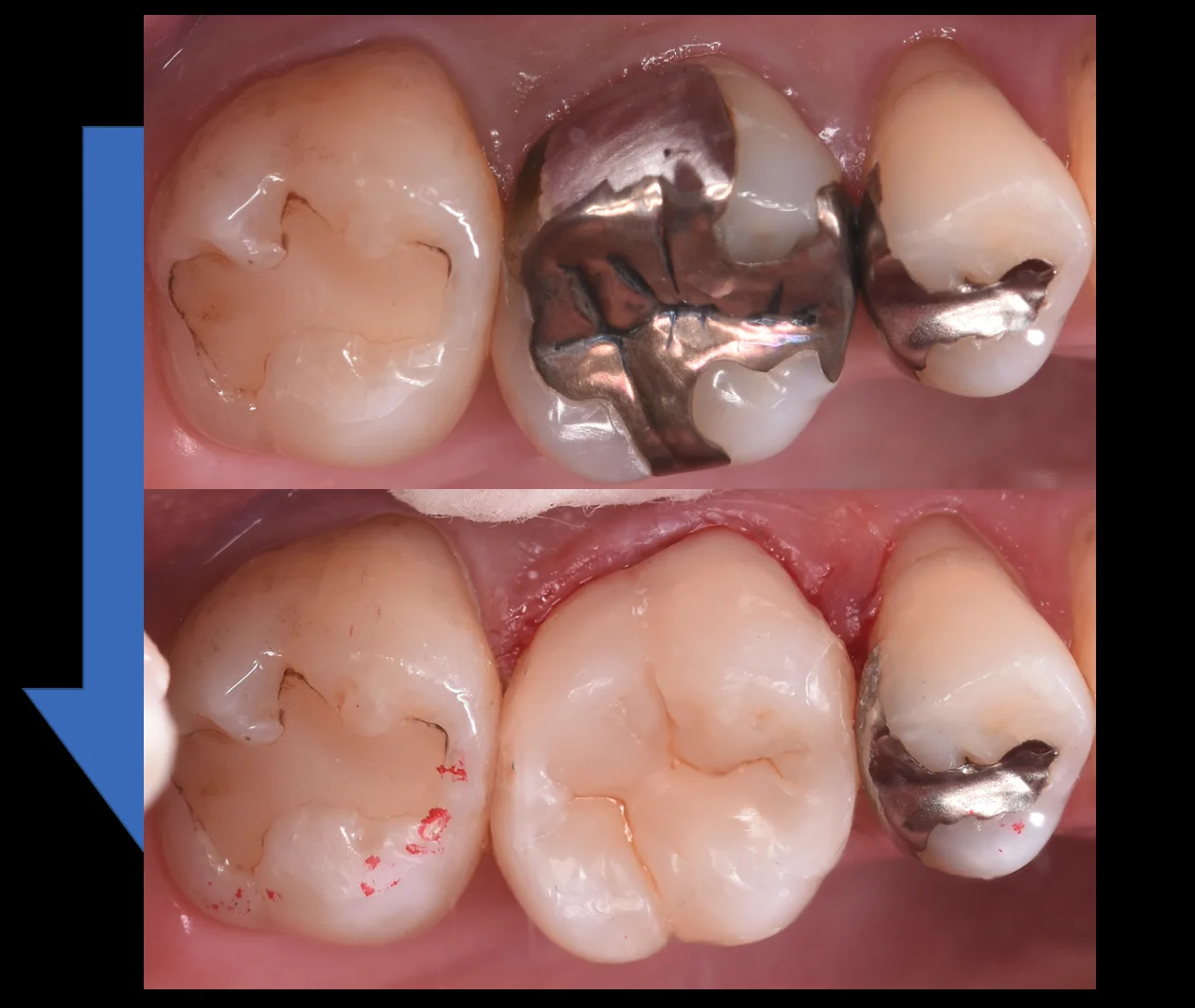 金属を白い詰め物に。｜坂寄歯科医院（取手市藤代） - 画像4