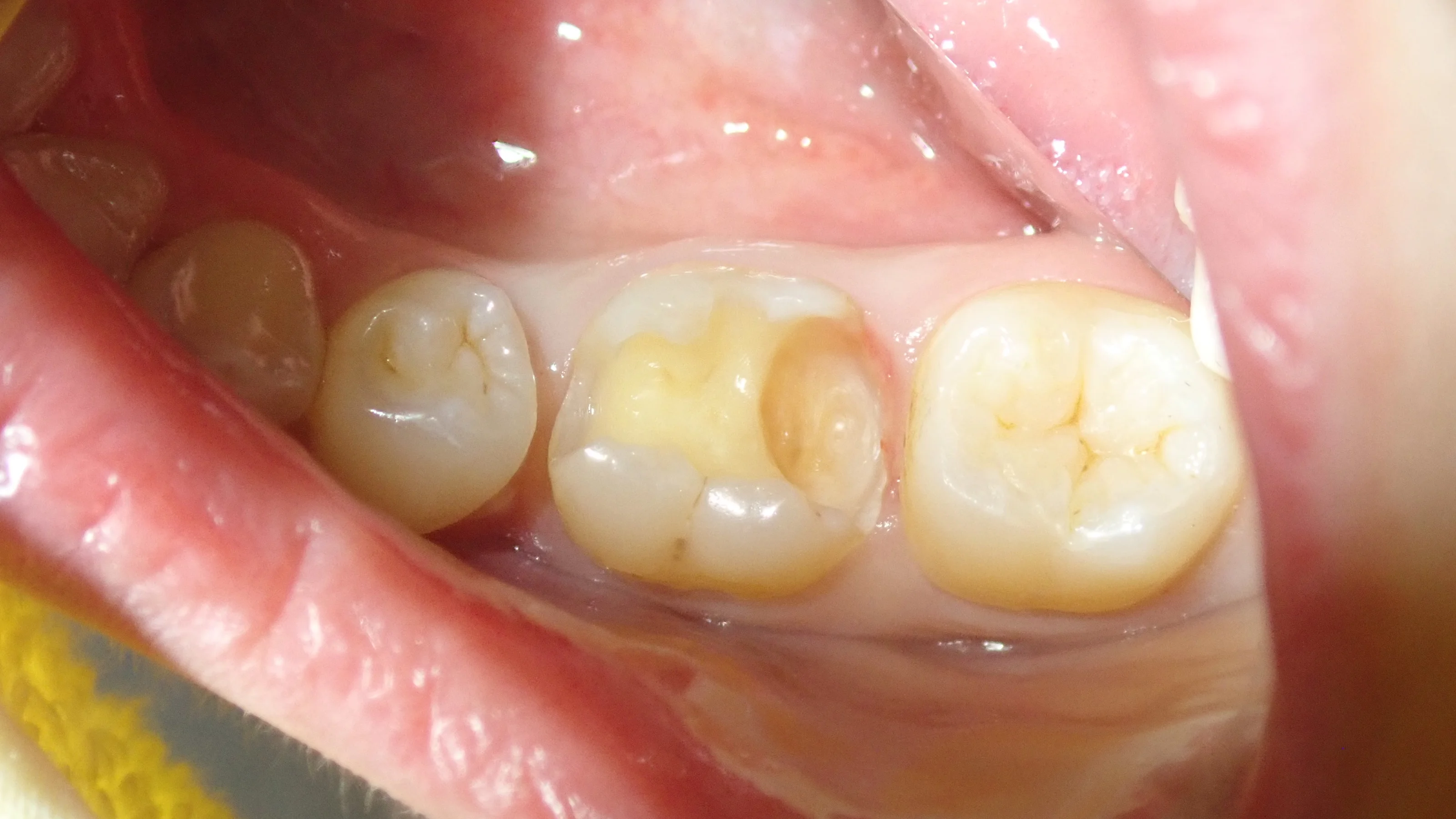 奥２本のダイレクトボンディング｜坂寄歯科医院（取手市藤代） - 画像6