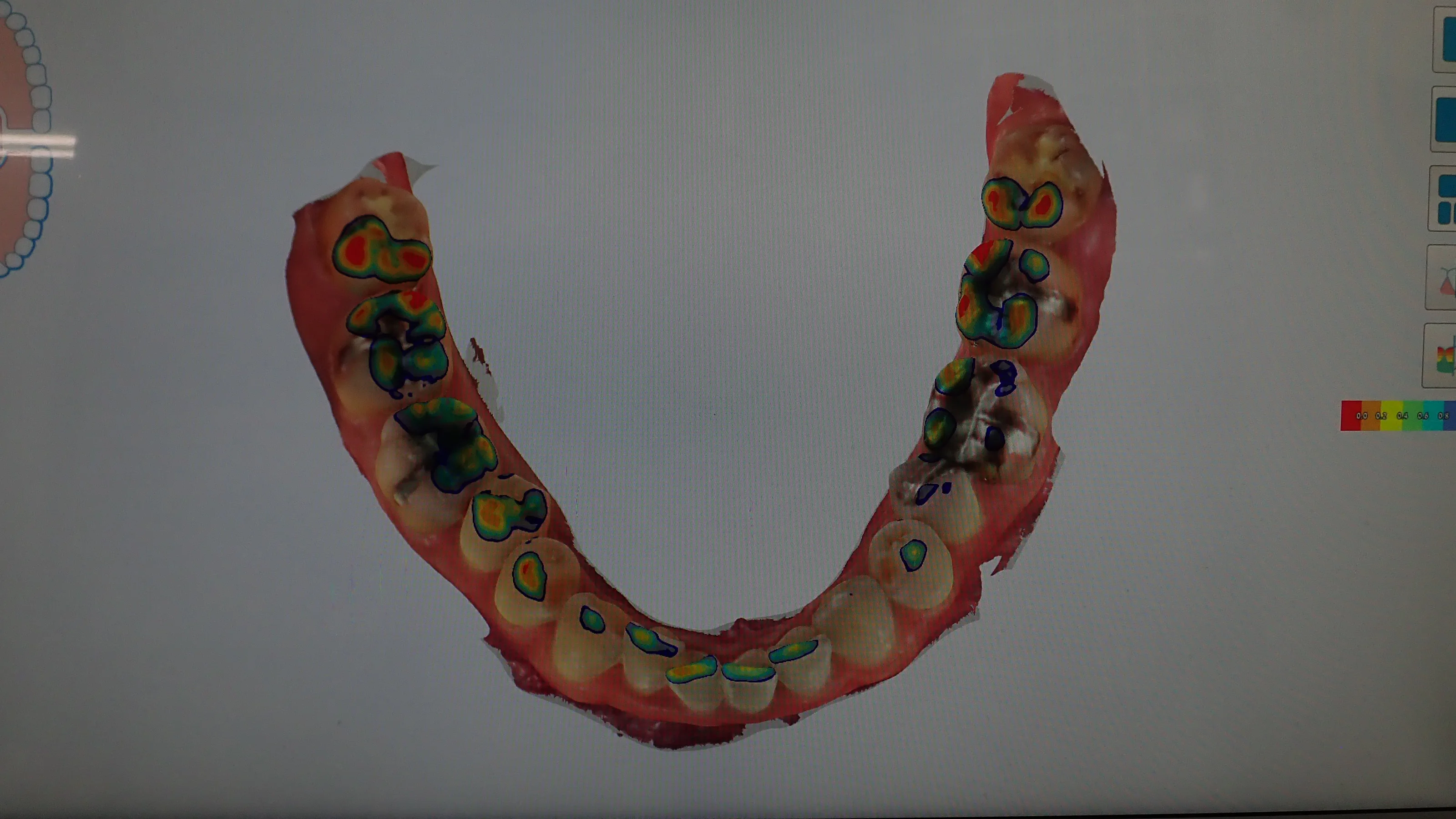 口腔内スキャナを導入しました。｜坂寄歯科医院（取手市藤代） - 画像3