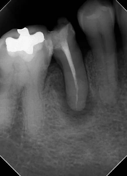閉鎖根管の治療には根気が必要｜坂寄歯科医院（取手市藤代） - 画像3