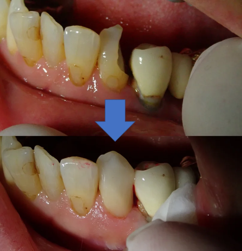 下顎前歯ダイレクトボンディング｜坂寄歯科医院（取手市藤代） - 画像4