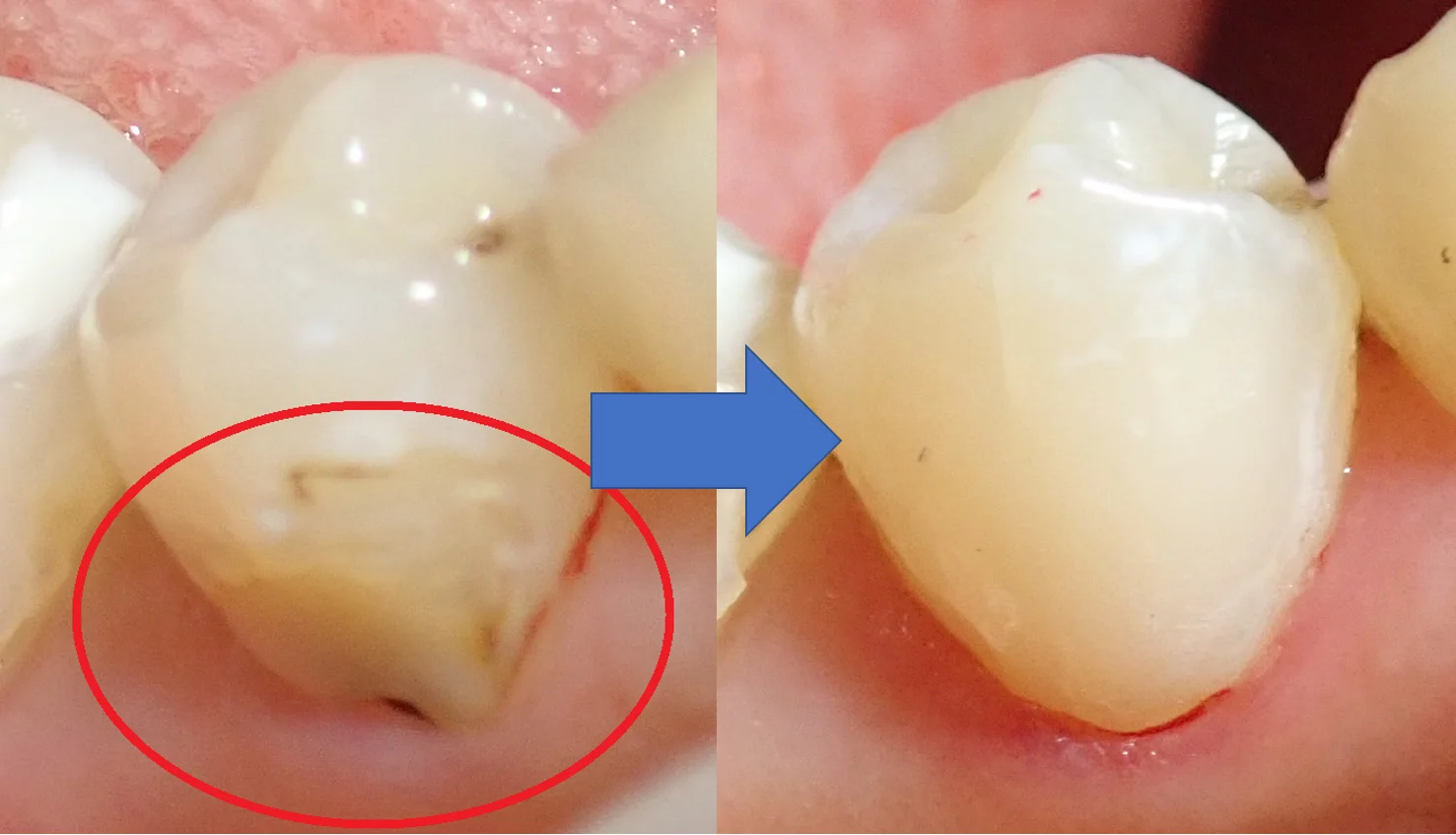 圧排糸を使ったレジン治療。｜坂寄歯科医院（取手市藤代） - 画像7