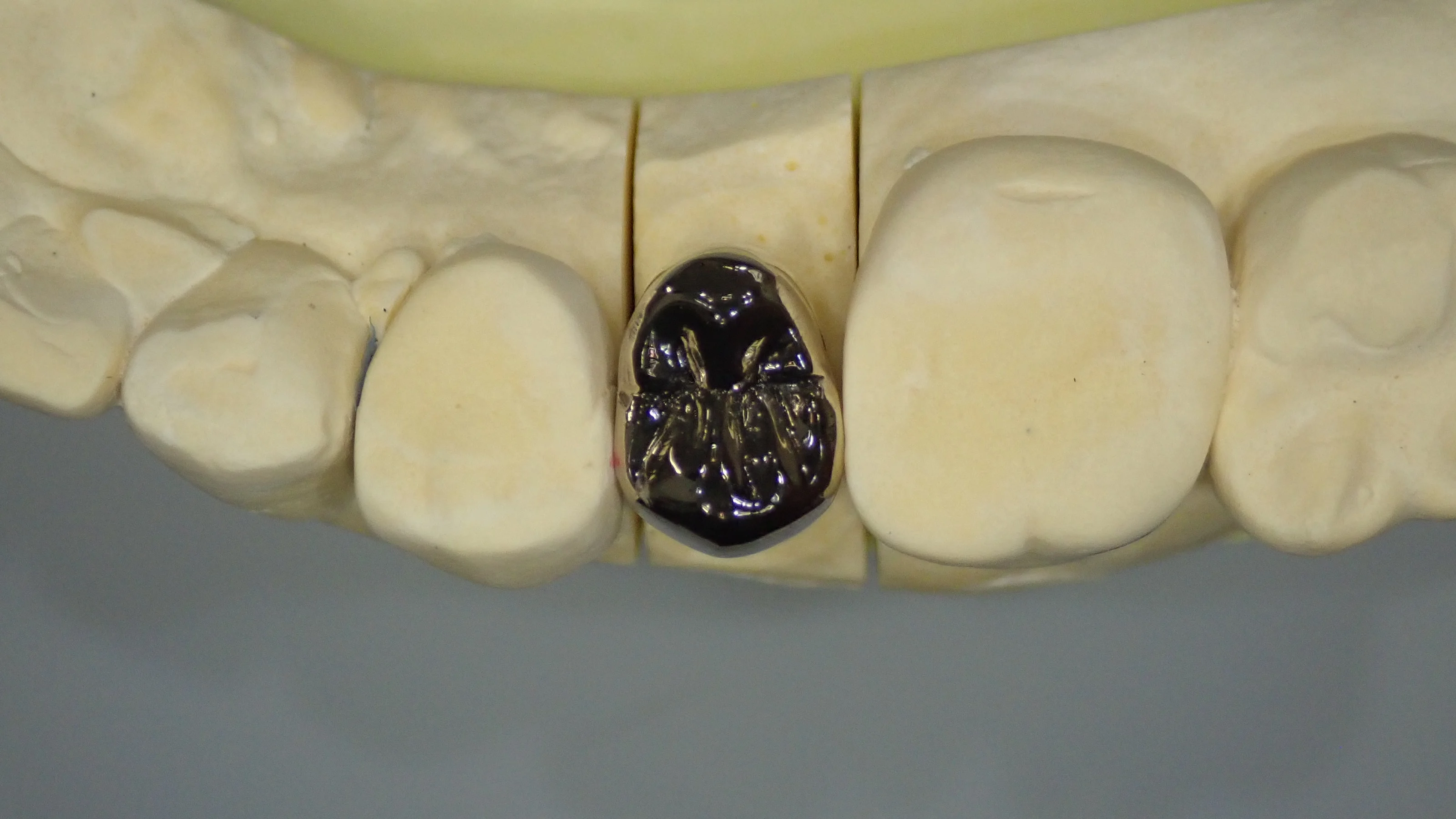 メタルクラウン｜坂寄歯科医院（取手市藤代） - 画像6