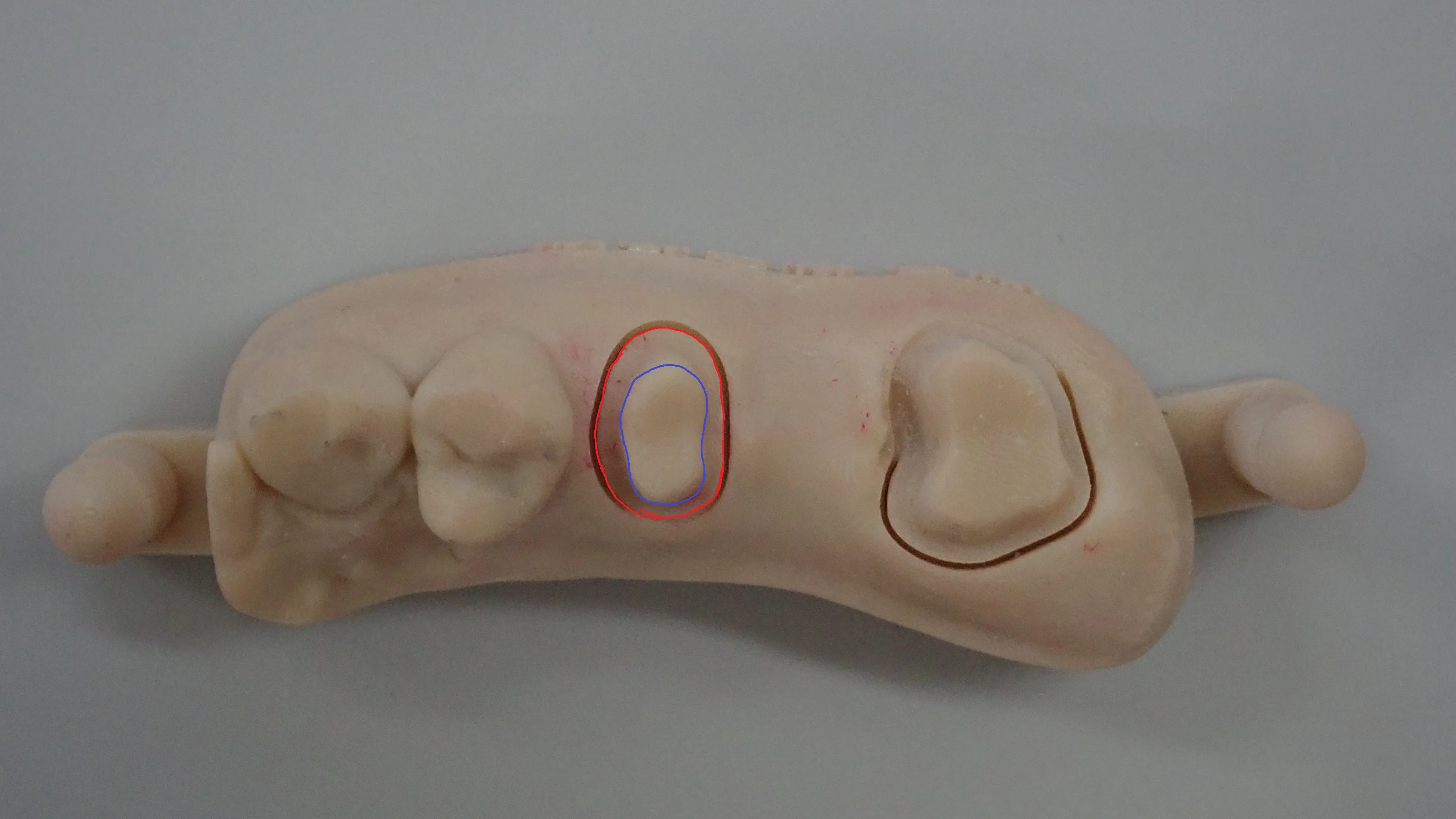 奥歯のセラミックブリッジ｜坂寄歯科医院（取手市藤代） - 画像2