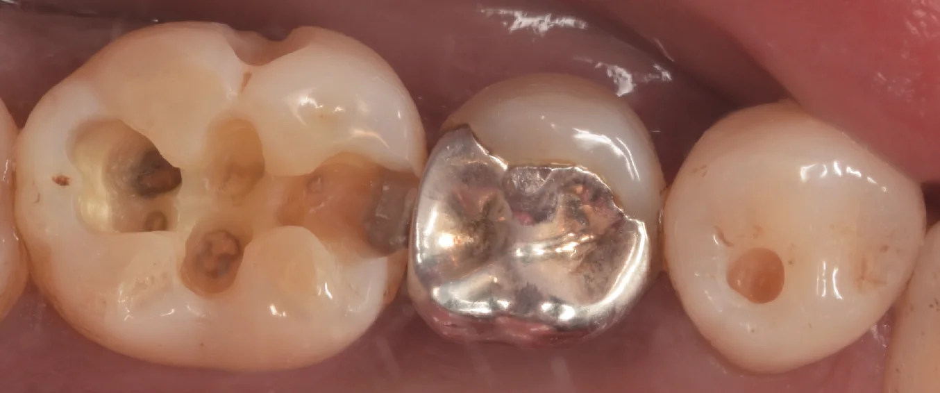古い金属にできた虫歯をその日のうちに白い詰め物で。｜坂寄歯科医院（取手市藤代） - 画像3