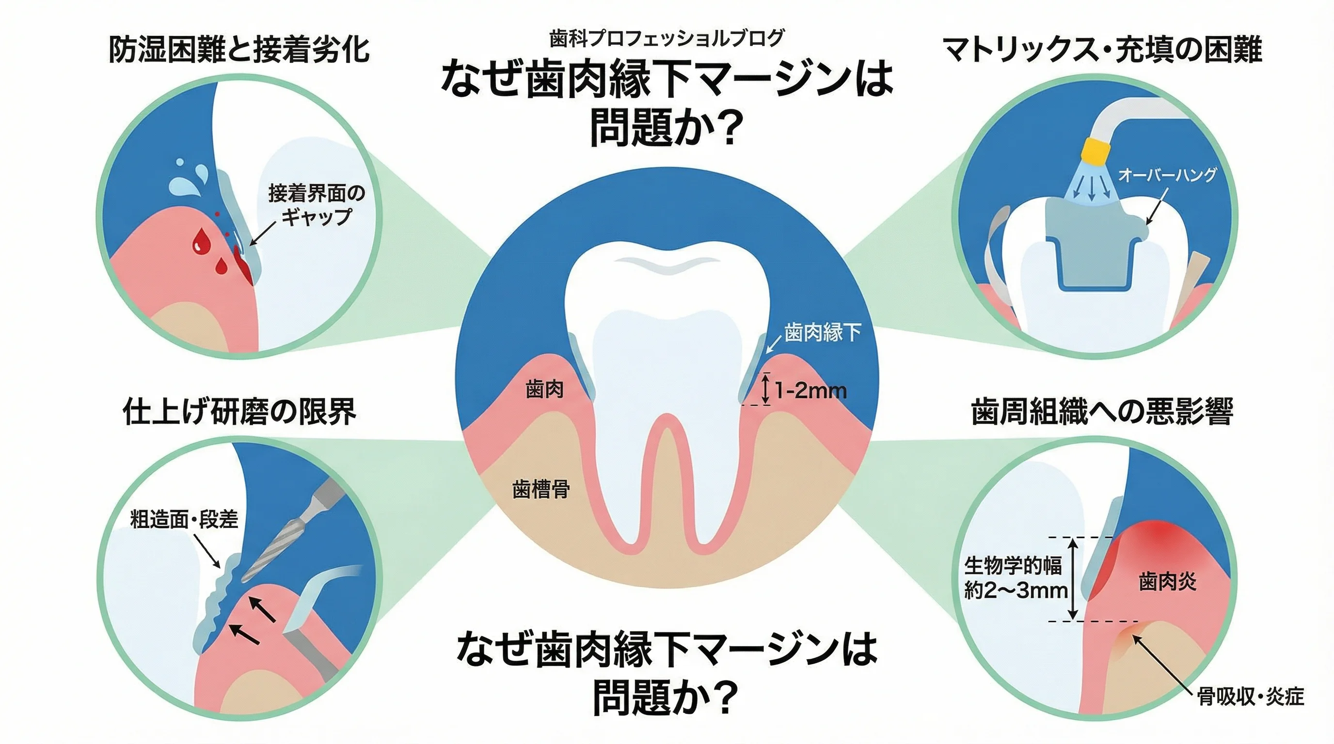なぜ歯肉縁下マージンが問題になるのかを、防湿困難・接着劣化・研磨の限界・マトリックス充填の難しさ・歯周組織への影響などの要因とともに示した解説図