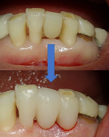 接着性ブリッジ｜坂寄歯科医院（取手市藤代） - 画像4