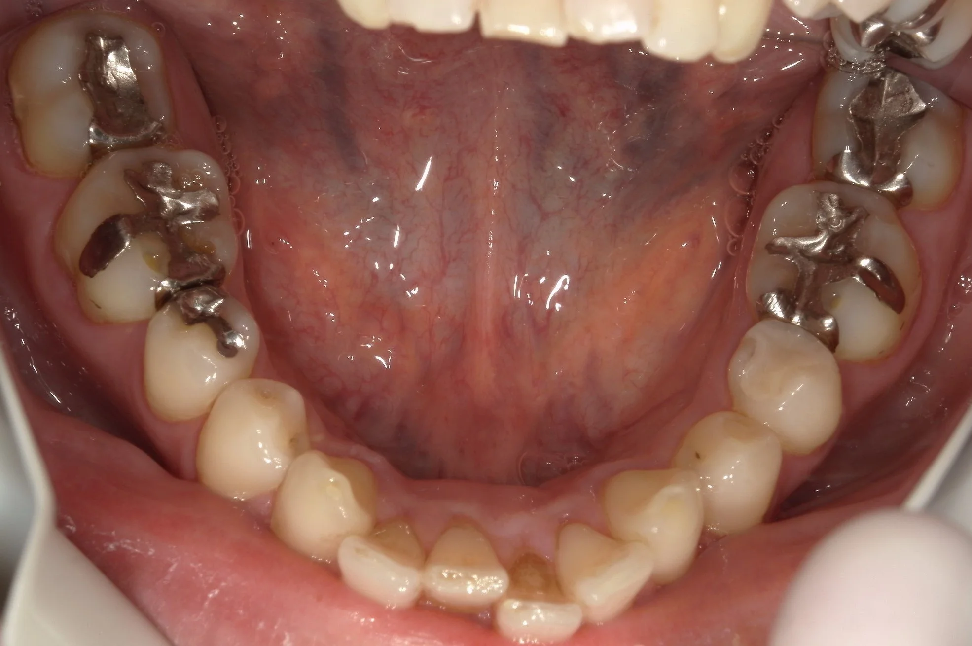 １回で纏めて一気に白い歯へ。｜坂寄歯科医院（取手市藤代） - 画像5