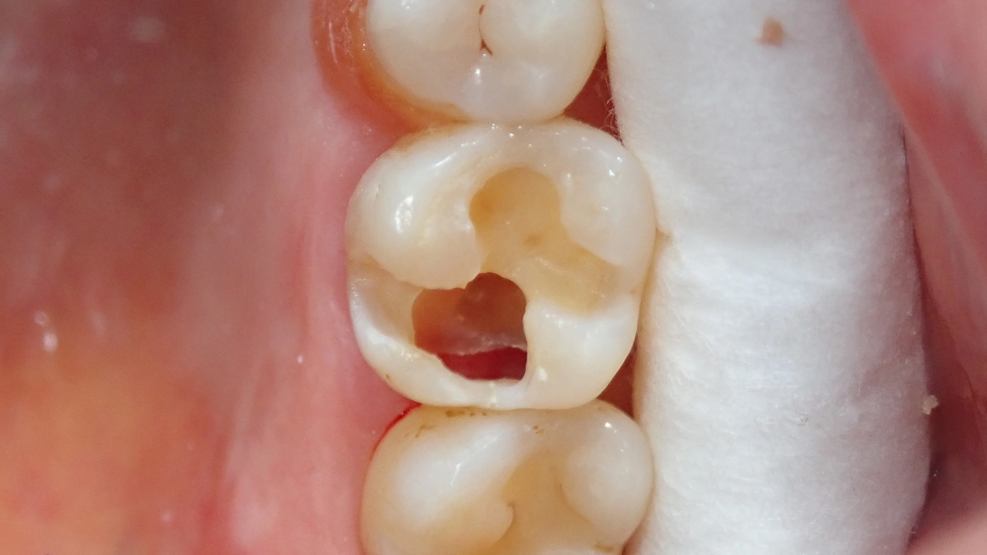 ダイレクトボンディング③(臼歯)|坂寄歯科医院(取手市藤代) - 画像2