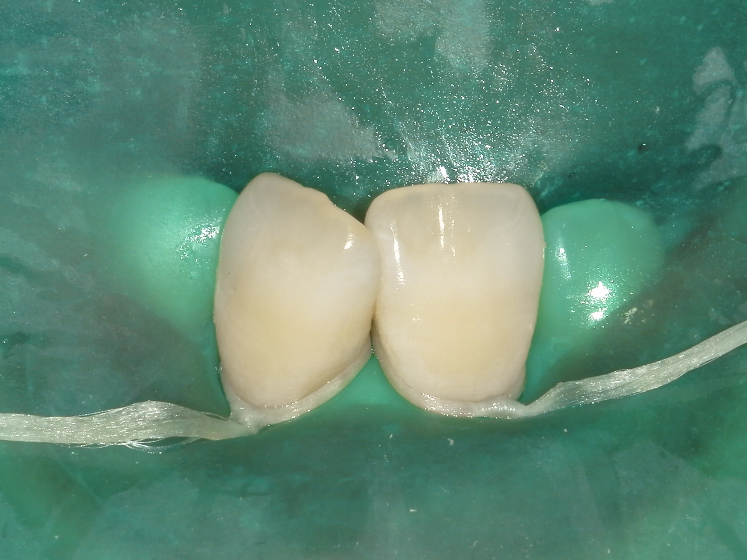 ICON治療(低侵襲ホワイトスポット改善治療)を始めました。|坂寄歯科医院(取手市藤代) - 画像5